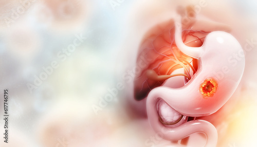 Tableau sur toile Stomach cancer, gastric cancer, symptoms, stages, treatment, 3d illustration
