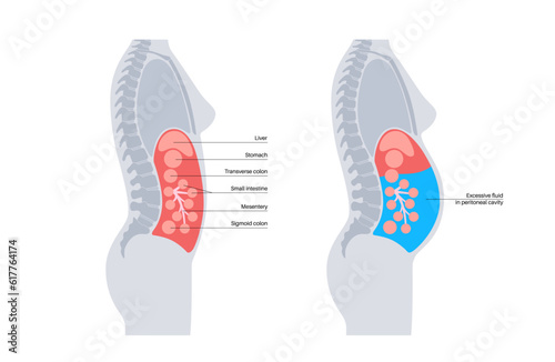 Ascites disease poster