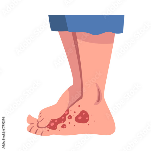Legs with Skin Problem Suffering from Itching Vector Illustration