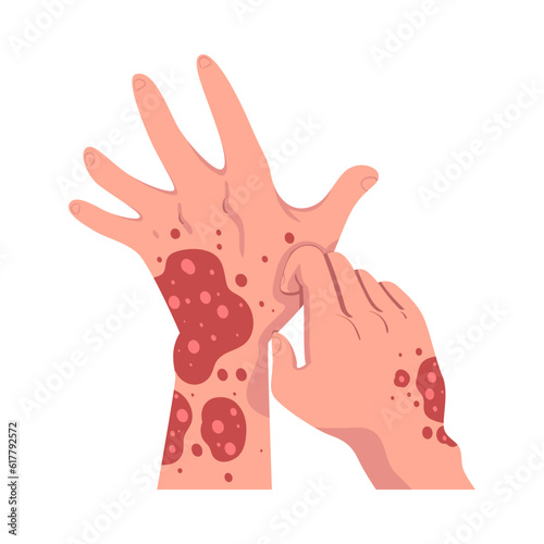 Hands with Skin Problem Suffering from Itching Vector Illustration
