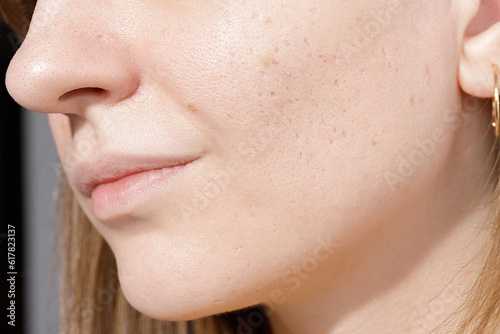 Fotografi Young woman suffering from problem skin and acne closeup