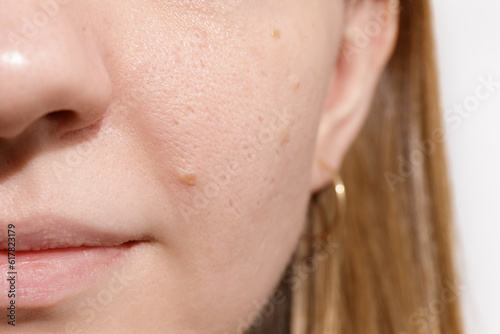 Skin problem with acne diseases, close up woman face with dry lip mouth, scar and oily greasy face, beauty concept. photo