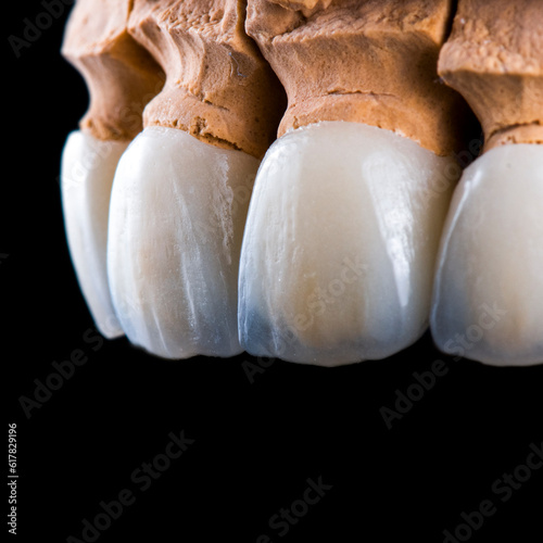 emax crowns on teeth and implants