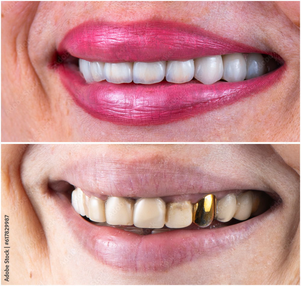 Obraz premium emax crowns on teeth and implants