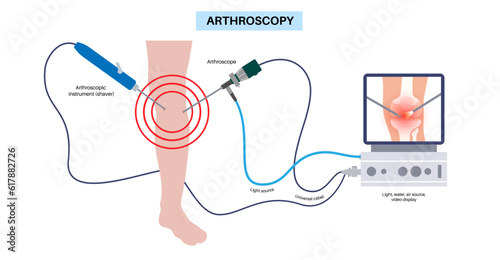 Knee joint arthroscopy