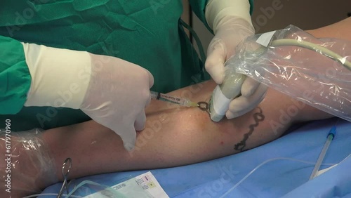 Varicose Spider Veins being treated in a hospital photo