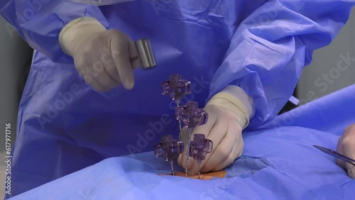 A Spine Vertebroplasty Procedure in the hospital photo