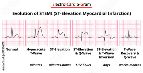 Evolution of STEMI (ST-Elecation Myocardial Infarction) - Electrocardiogram Medical Vector Illustration