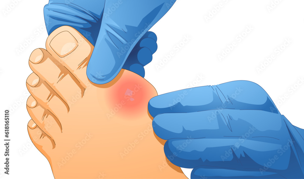Bump on the leg. Foot with gout. Hallux valgus. Healthcare illustration