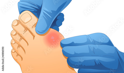 Bump on the leg. Foot with gout. Hallux valgus. Healthcare illustration. Vector illustration