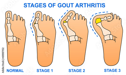 Stages of gout arthritis. Bump on the leg. Foot with gout. Hallux valgus. Healthcare illustration. Vector illustration photo