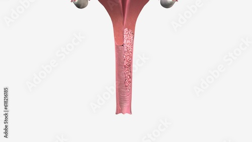 Stage 3 means the cancer has spread away from the cervix and into surrounding structures in the pelvis (the area between the hip bones) photo