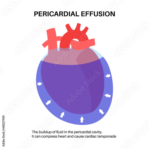 Pericardial effusion heart