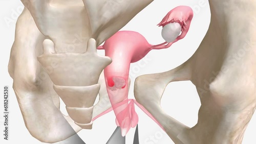 Pelvic inflammatory disease is an infection of a woman's reproductive organs