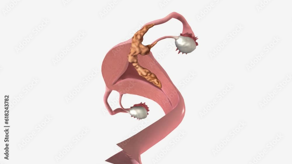 stages-of-uterine-cancer