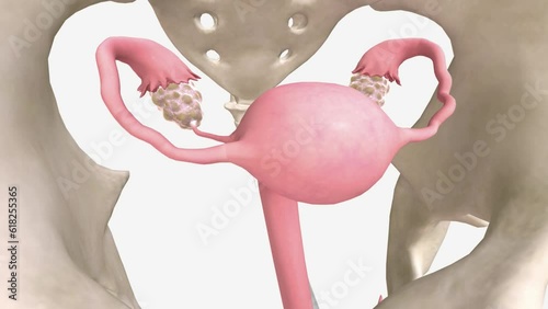 Polycystic ovary syndrome is a condition where you have few, unusual or very long periods photo