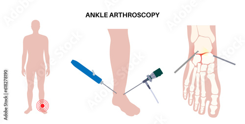 Ankle arthroscopy poster