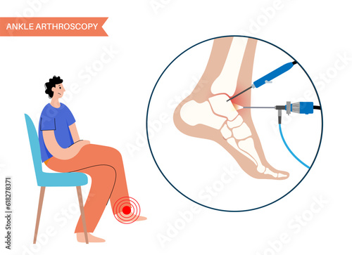 Ankle arthroscopy poster