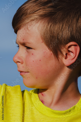 Φωτογραφία Outdoors portrait of boy with chicken pox
