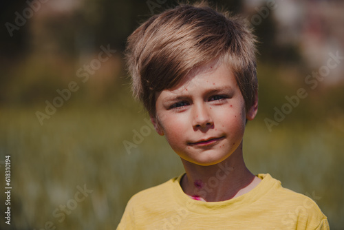 Εκτύπωση καμβά Outdoors portrait of boy with chicken pox