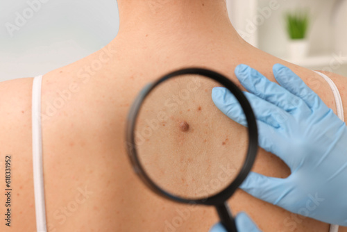 Dermatologist examining patient's birthmark with magnifying glass indoors, closeup