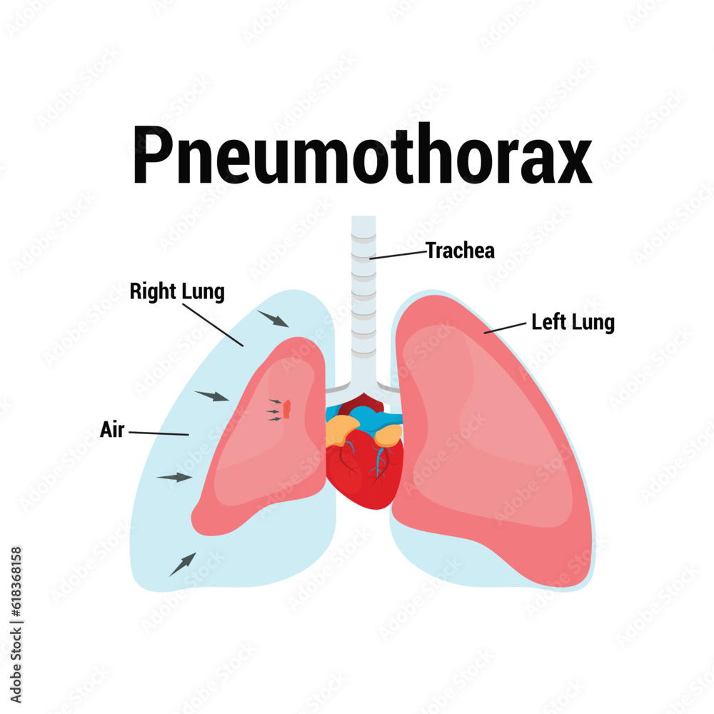 symptoms of pneumothorax lung vector symptoms of pneumothorax lung vector
