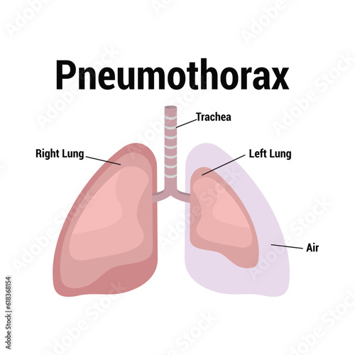 symptoms of pneumothorax lung vector
