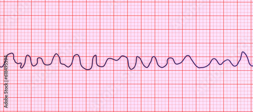Fotografie Electrocardiogram ECG displaying ventricular fibrillation rhythm, 3D illustratio