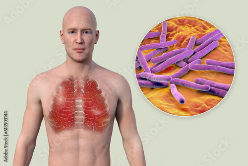 A 3D illustration showcasing the upper half part of a man with transparent skin, revealing the lungs affected by miliary tuberculosis photo