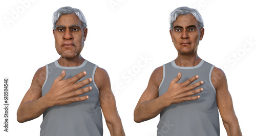 A man suffering from acromegaly, 3D illustration