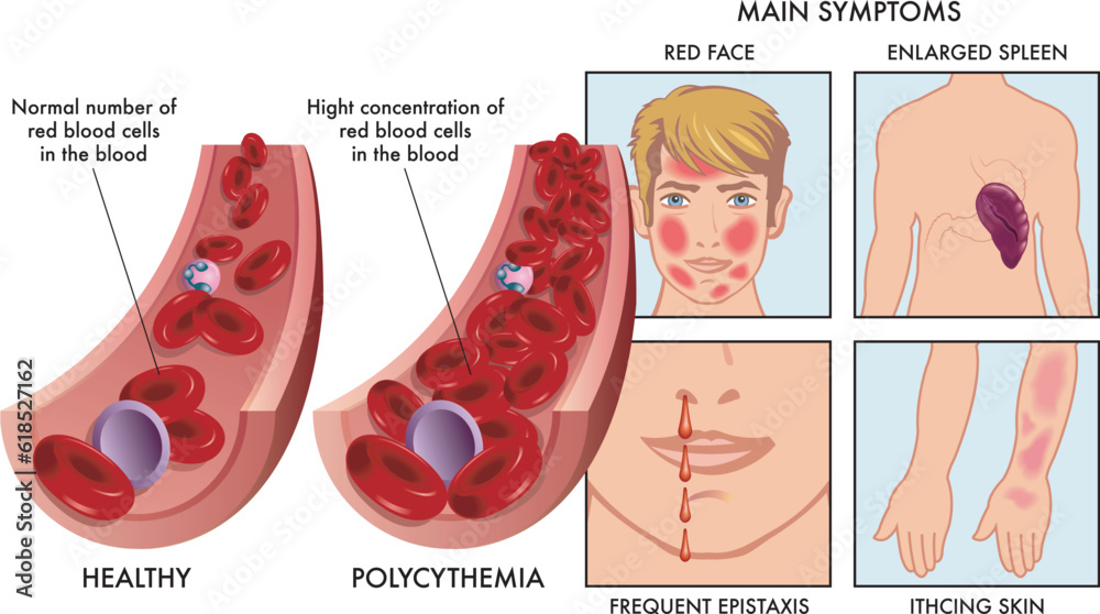 Medical illustration compares an artery with a normal number of red blood cells, with one affected by polycythemia, with drawings to the right showing symptoms, completed with annotations. - obrazy, fototapety, plakaty 
