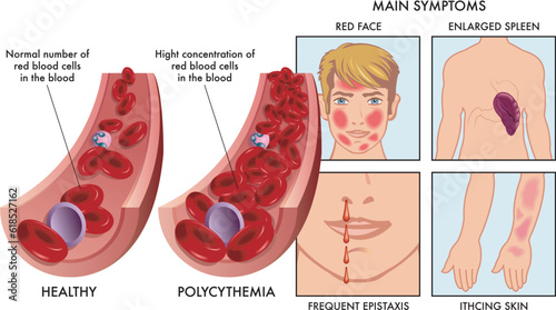 Medical illustration compares an artery with a normal number of red blood cells, with one affected by polycythemia, with drawings to the right showing symptoms, completed with annotations.