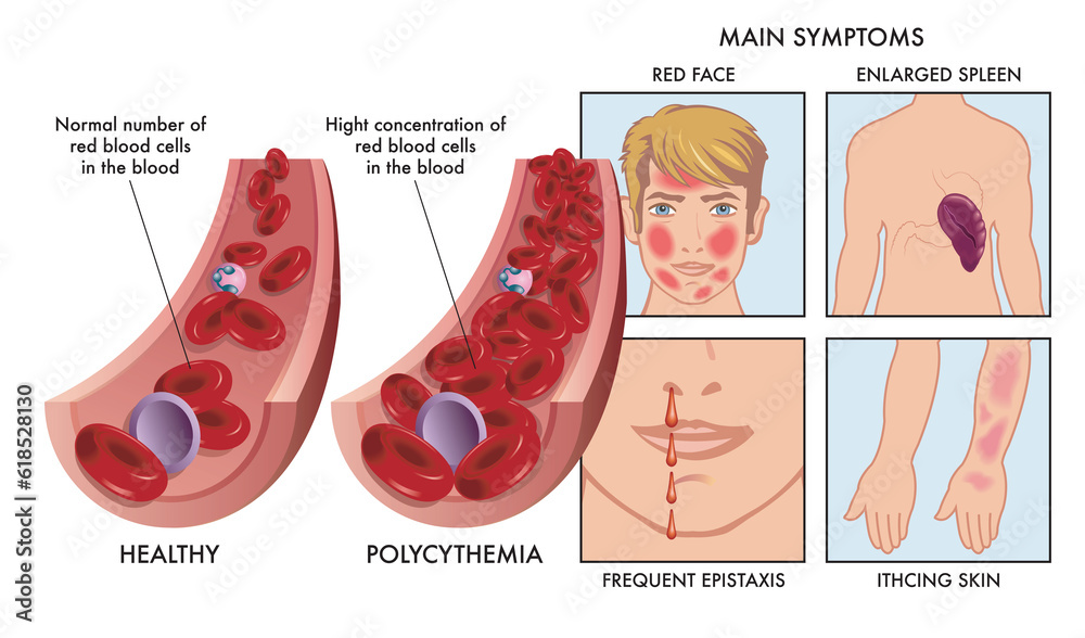Medical illustration compares an artery with a normal number of red blood cells, with one affected by polycythemia, with drawings to the right showing symptoms, completed with annotations. - obrazy, fototapety, plakaty 