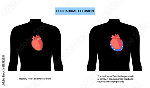 Pericardial effusion heart photo