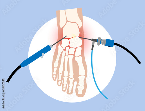 Ankle arthroscopy poster