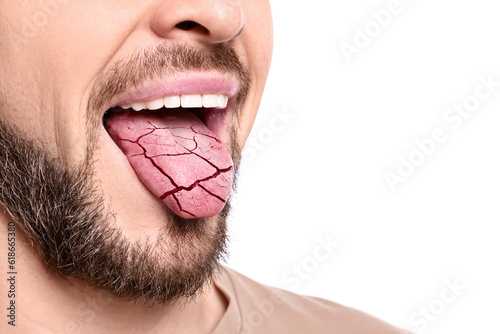 Dry mouth symptom. Man showing dehydrated tongue on white background, closeup photo
