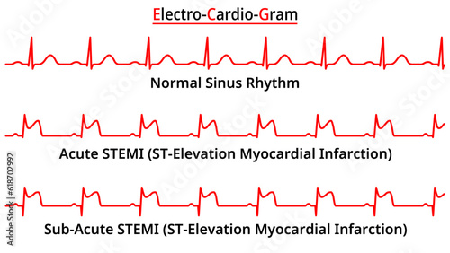 Set of ECG Common Abnormalities - Acute - SubAcute STEMI (ST-Elevation Myocardial Infarction) - Normal Sinus Rhythm - Electrocardiography Vector Medical Illustration