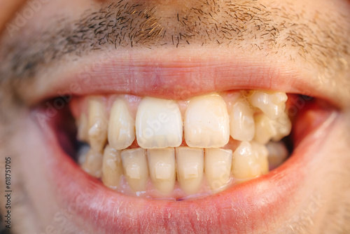 Curved male teeth, before installing braces. Close - up of teeth before treatment by an orthodontist