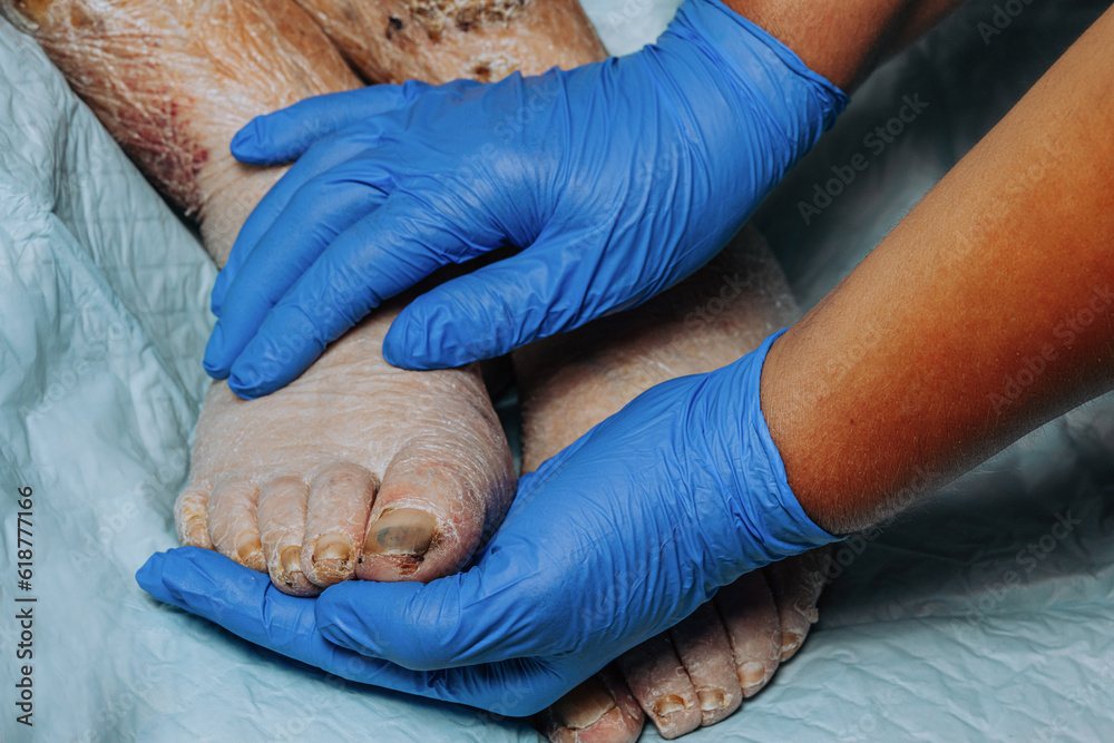 On the legs of an elderly woman, the skin peels off due to eczema