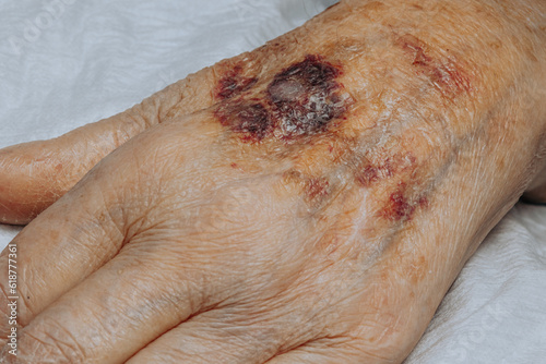 A bruise on the hand of an elderly person. Known as senile purpura. Caused by the fragility of the skin and blood vessels in old age. Elderly care