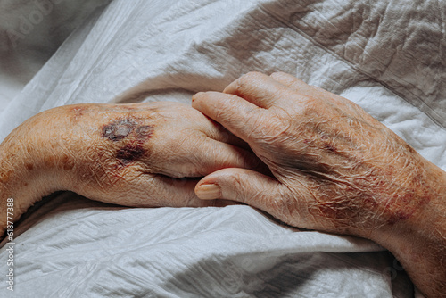 Fotografía A bruise on the hand of an elderly person