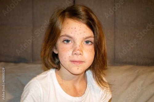 Bilde på lerret Varicella virus or Chickenpox bubble rash on child