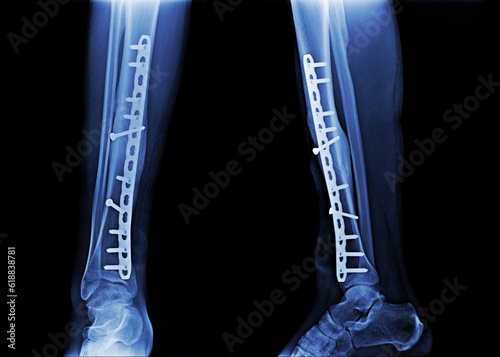  leg fracture and surgical treatment by internal fixation with plate and screw 