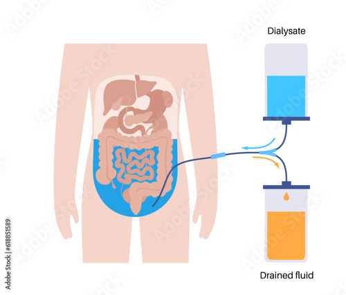 Peritoneal dialysis concept