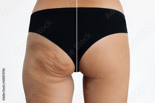 Young tanned woman's buttocks with cellulite before after treatment and sports isolated on a white background. Getting rid of excess weight. Result of diet, massage, sports. Improving skin on thighs