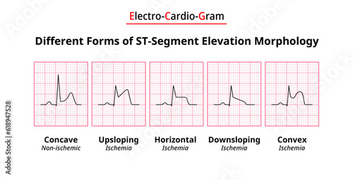 Different Forms of ST-Segment Elevation Morphology - ECG Ischemia - Non ischemic - Electrocardiography Vector Medical Illustration