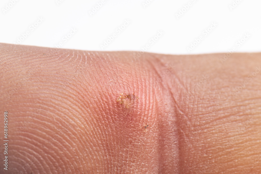 Finger with infection from wood splinter Finger with infection from wood splinter