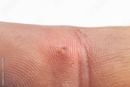 Finger with infection from wood splinter