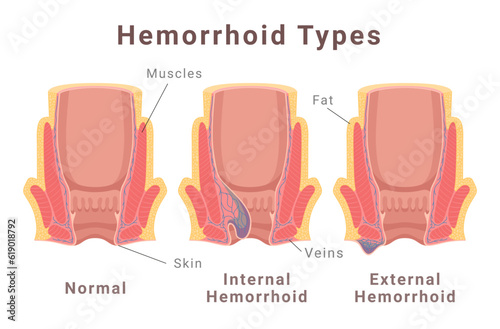 Hemorrhoid types scheme with normal internal and external poster isometric vector illustration