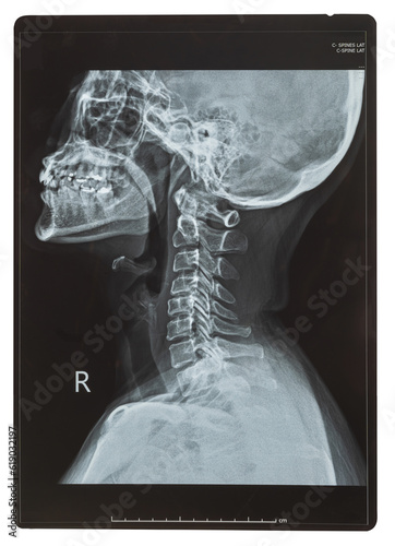 C-spine x-ray or Cervical spine image lateral views of female patient for doctor diagnosis on intervertebral disc herniation or Cervical radiculopathy, Spondylosis and fracture